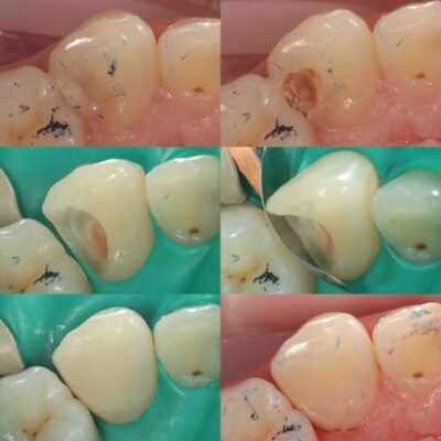 лечение зуба спб недорого