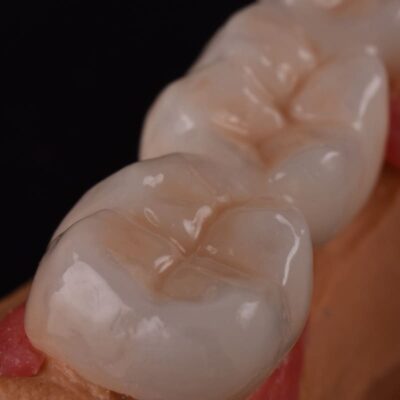 стоматология спб протезирование зубов цены