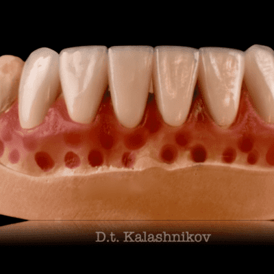 стоматологическое протезирование зубов спб