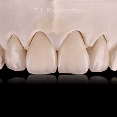 протезирование зубов в спб недорого под ключ