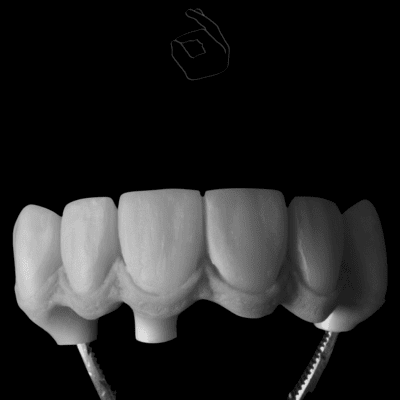 виды протезирования зубов в спб